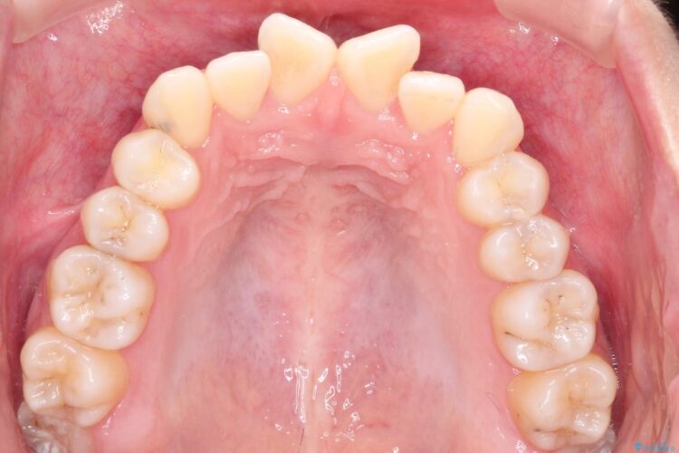 インビザラインによる非抜歯矯正　ガタガタな歯並びを整った歯並びへ 治療前画像