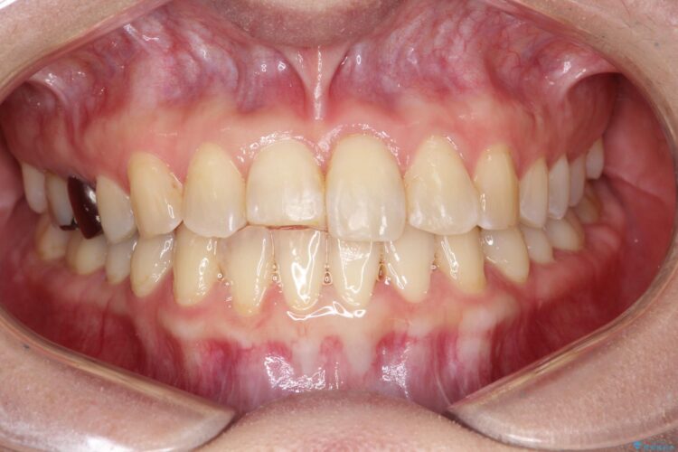 インビザラインにて矯正　その後に前歯のセラミッククラウン治療 治療途中画像