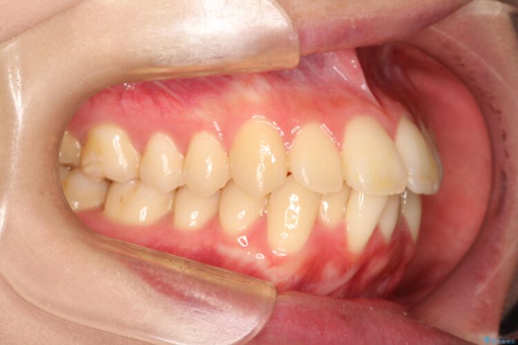 口元が出てるの気になる　ハーフリンガルによる抜歯矯正での横顔改善 治療前画像