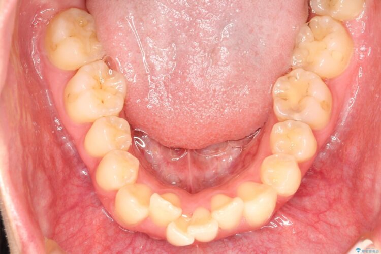 口元が出てるの気になる　ハーフリンガルによる抜歯矯正での横顔改善 治療前画像