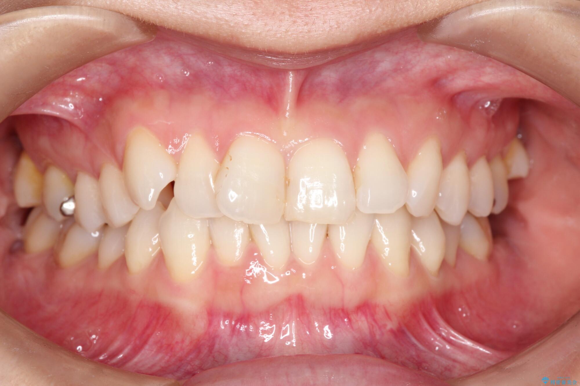八重歯と前歯のガタガタをインビザラインで 治療前