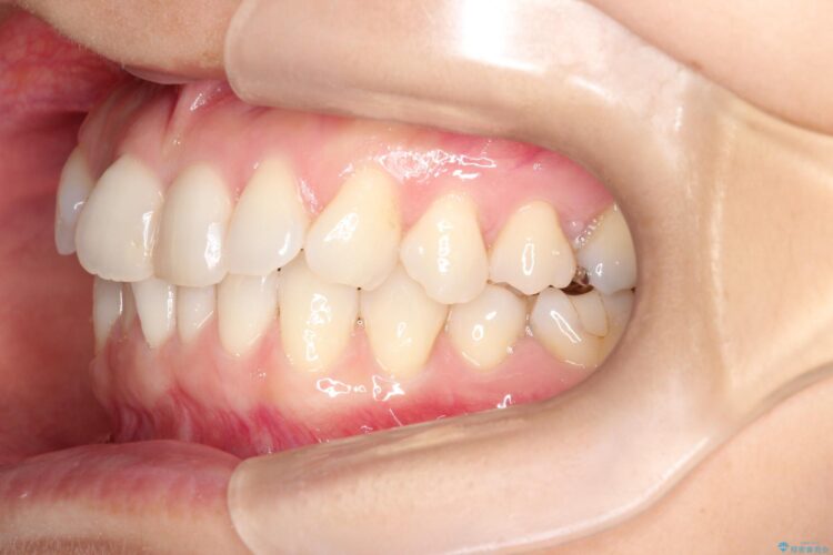 八重歯と前歯のガタガタをインビザラインで 治療前画像
