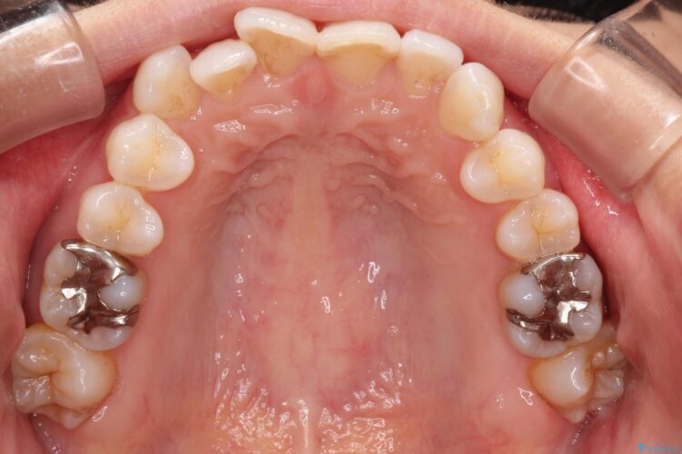 八重歯と前歯のガタガタをインビザラインで 治療前画像