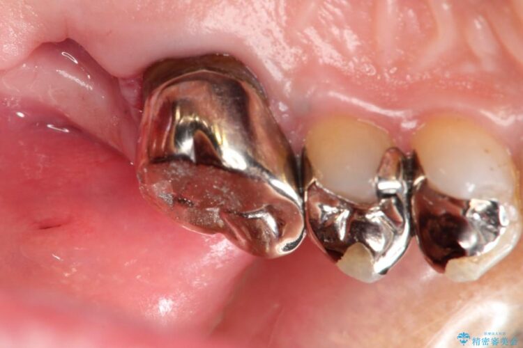 根管治療とインプラント治療で奥歯でしっかりと咬めるように 治療前画像