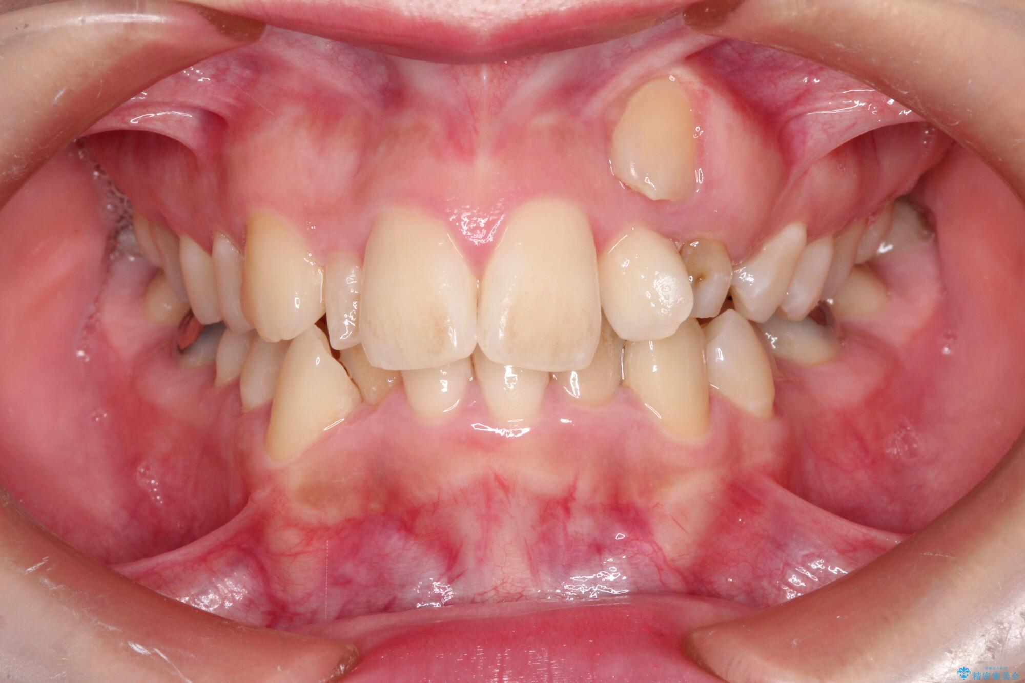 犬歯が変な位置にある　抜歯矯正により正しい位置へ 治療前