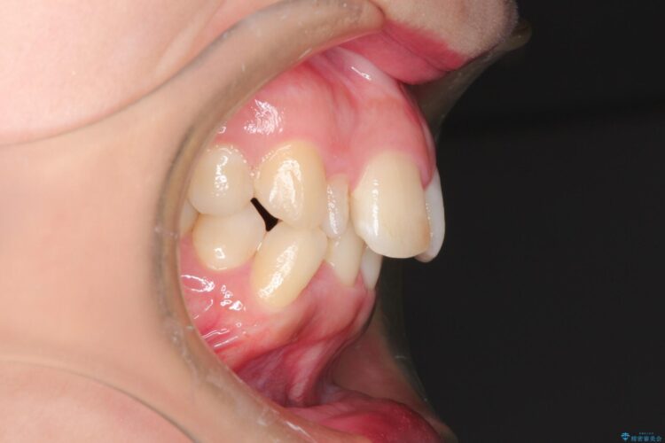 犬歯が変な位置にある　抜歯矯正により正しい位置へ 治療前画像