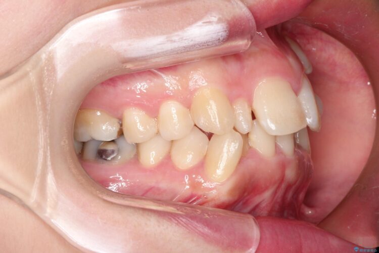 犬歯が変な位置にある　抜歯矯正により正しい位置へ 治療前画像