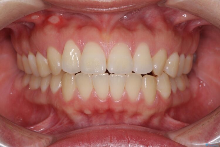 [口ゴボ] 　ワイヤーによる抜歯矯正で口元をすっきりと 治療前画像