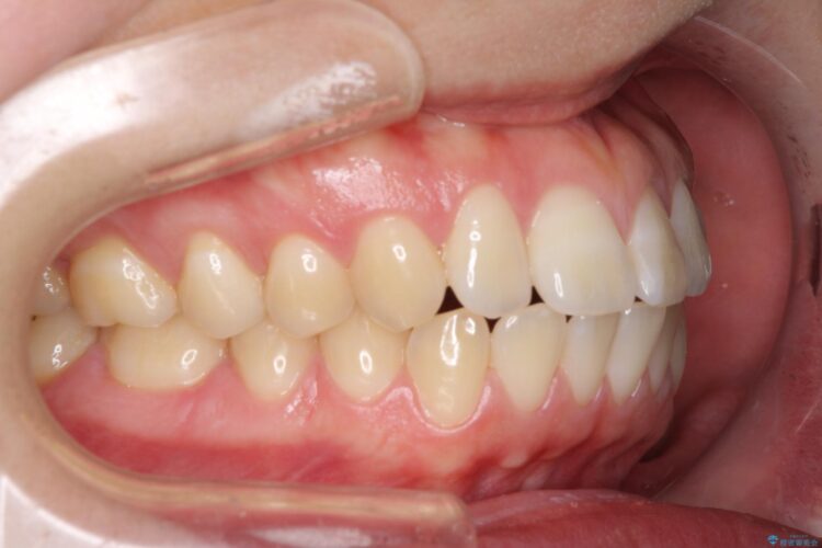 [口ゴボ] 　ワイヤーによる抜歯矯正で口元をすっきりと 治療前画像