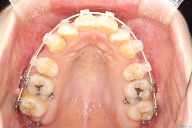重度のガタガタ　ワイヤーによる抜歯矯正 治療途中画像