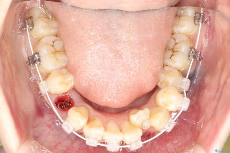 重度のガタガタ　ワイヤーによる抜歯矯正 治療途中画像