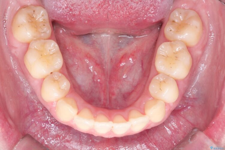 [口ゴボ] 　ワイヤーによる抜歯矯正で口元をすっきりと 治療後画像