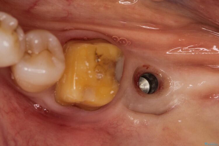 失った歯をインプラントで咬合回復 治療途中画像