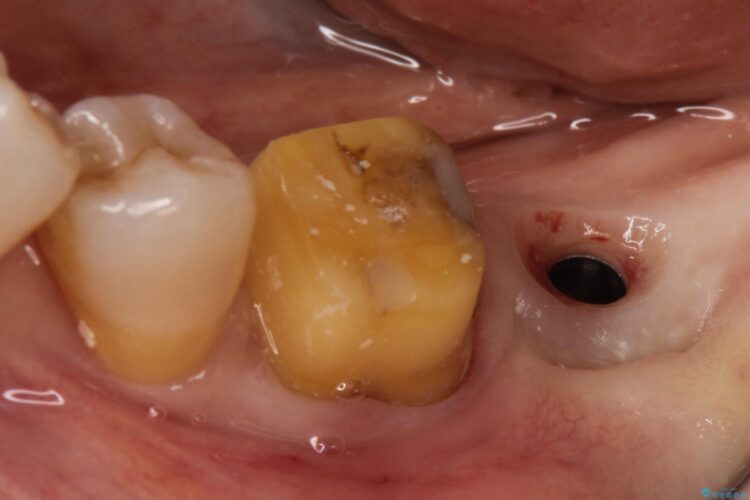失った歯をインプラントで咬合回復 治療途中画像