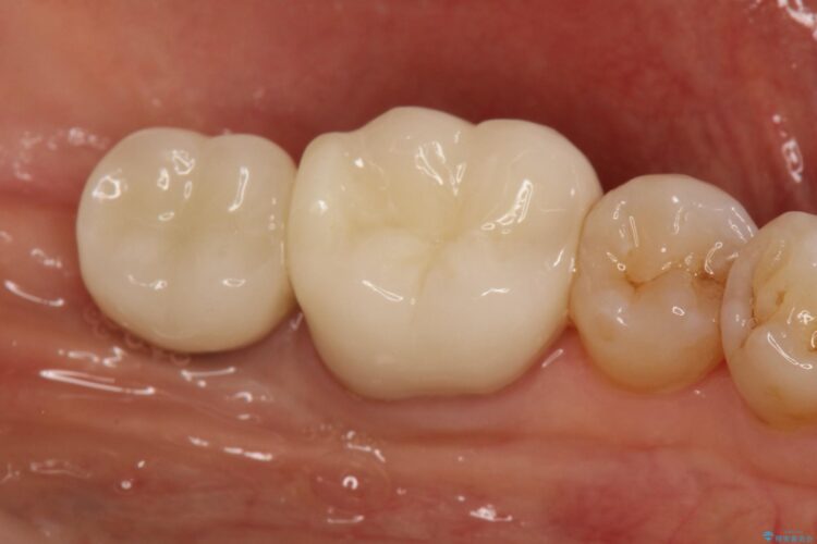 失った歯をインプラントで咬合回復 治療後画像