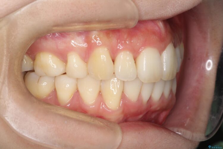 裏側装置で出っ歯の矯正治療 治療後画像