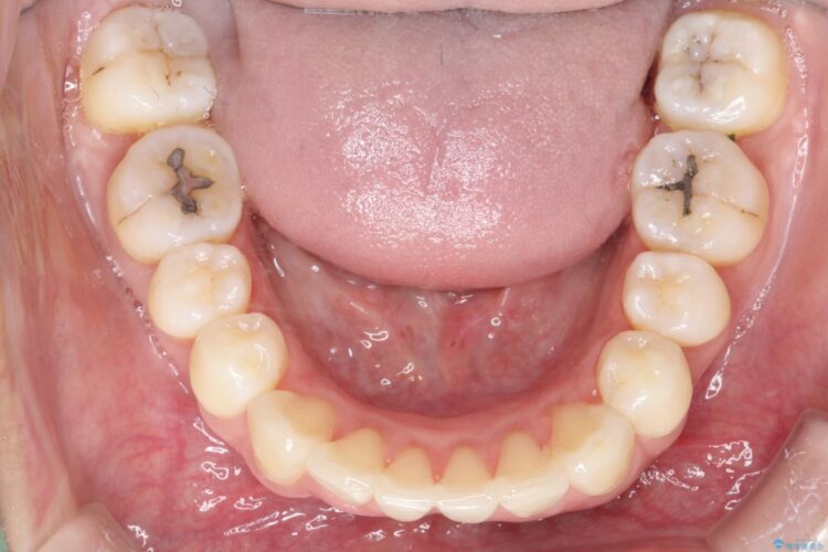 裏側装置で出っ歯の矯正治療 治療後画像
