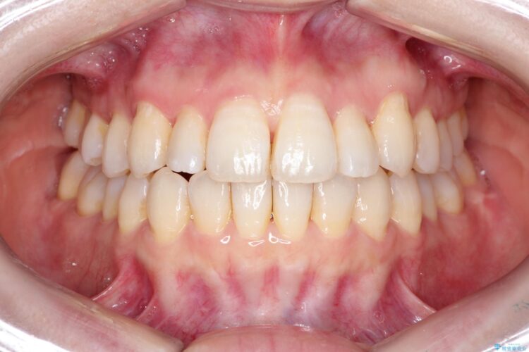 インビザラインによる八重歯の矯正　 治療後画像