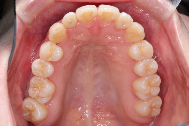 インビザラインによる八重歯の矯正　 治療後画像