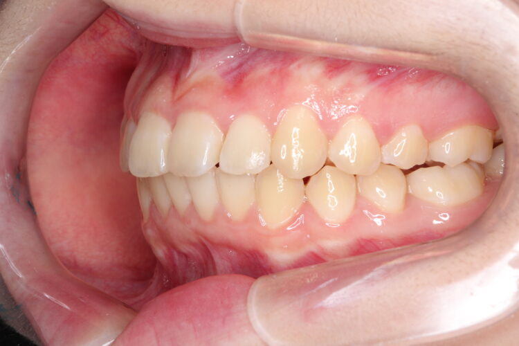 通院回数を減らして矯正したい　インビザラインでの歯並び矯正 治療後画像