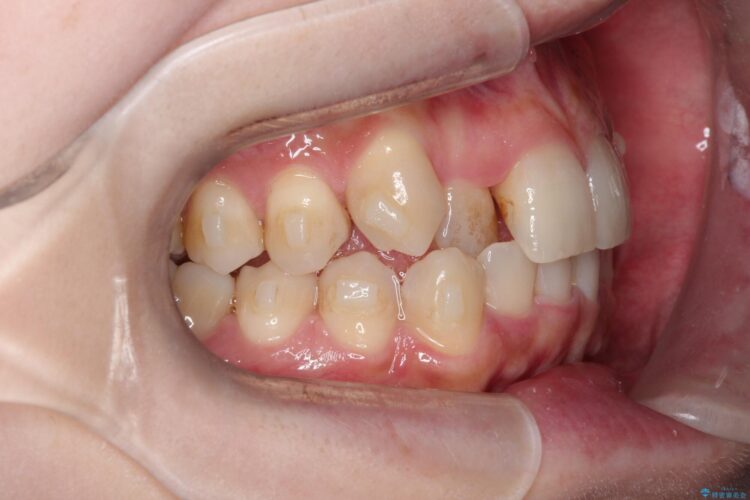八重歯を抜歯せずにインビザラインで矯正 治療途中画像