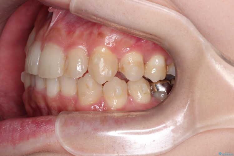 八重歯を抜歯せずにインビザラインで矯正 治療途中画像