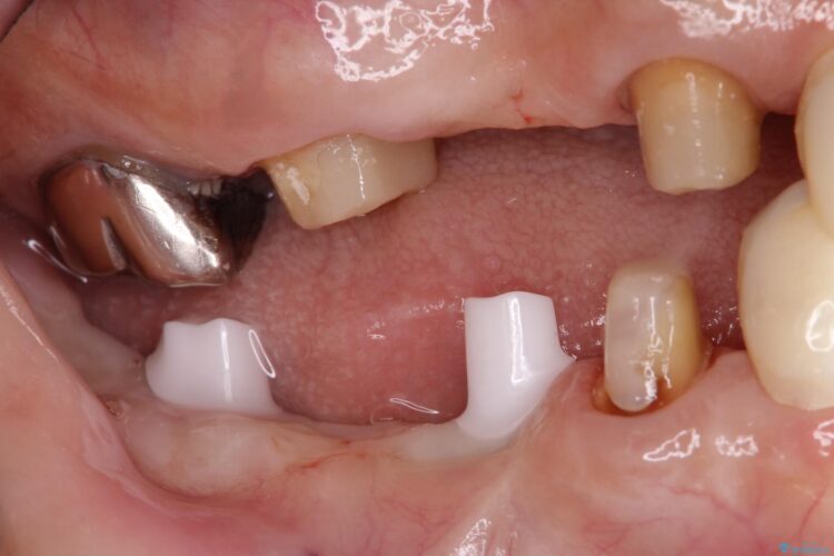 失った奥歯　インプラントブリッジで咬合回復 治療途中画像