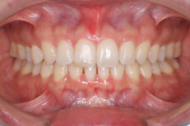 すきっ歯をインビザラインで目立たたずストレスなく矯正 アフター