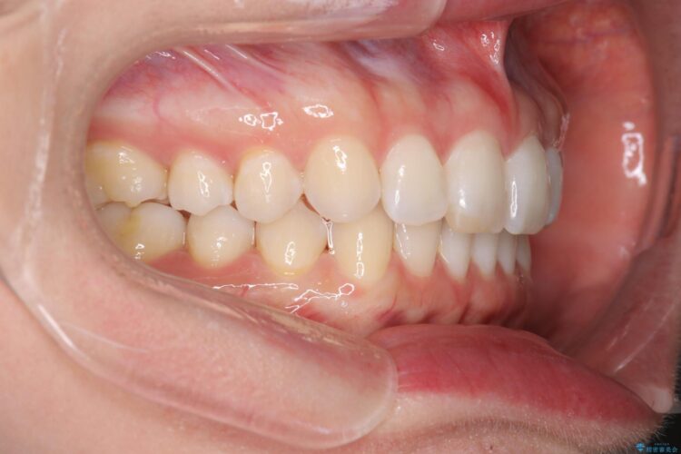 すきっ歯をインビザラインで目立たたずストレスなく矯正 治療後画像
