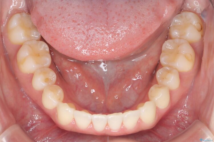 すきっ歯をインビザラインで目立たたずストレスなく矯正 治療後画像
