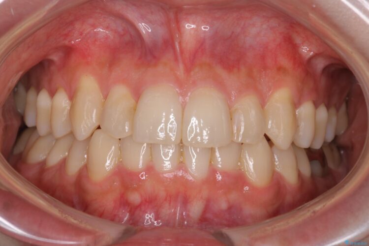 八重歯を抜歯せずにインビザラインで矯正 治療後画像