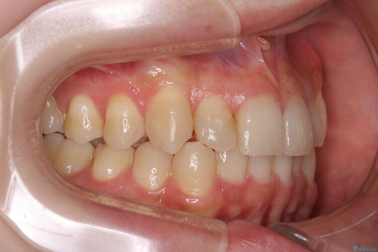 八重歯を抜歯せずにインビザラインで矯正 治療後画像