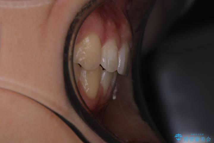 出っ歯の矯正　抜歯をしてしっかり引っ込めるワイヤー矯正 治療後画像