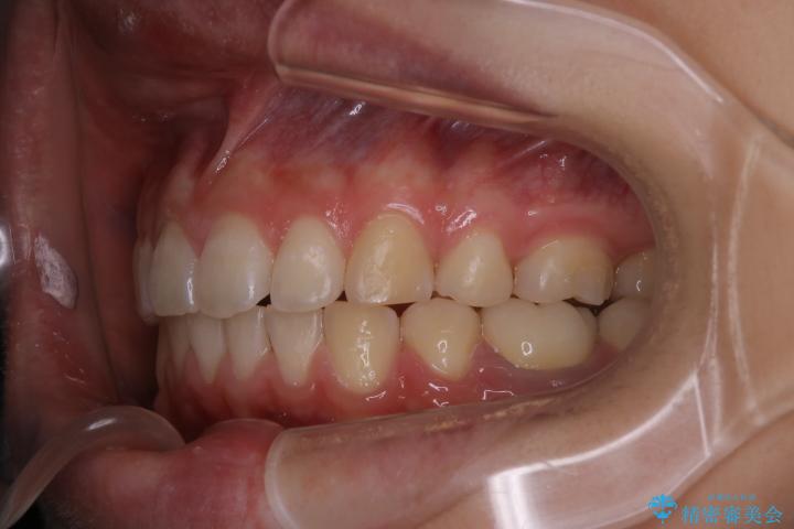出っ歯の矯正　抜歯をしてしっかり引っ込めるワイヤー矯正 アフター