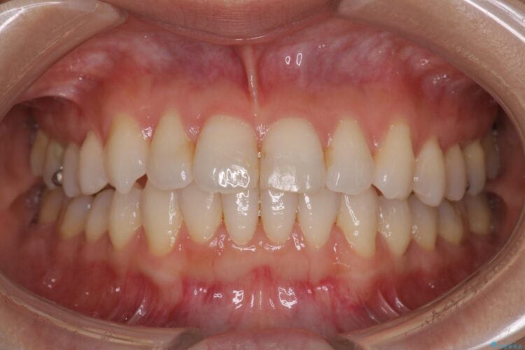 八重歯と前歯のガタガタをインビザラインで アフター