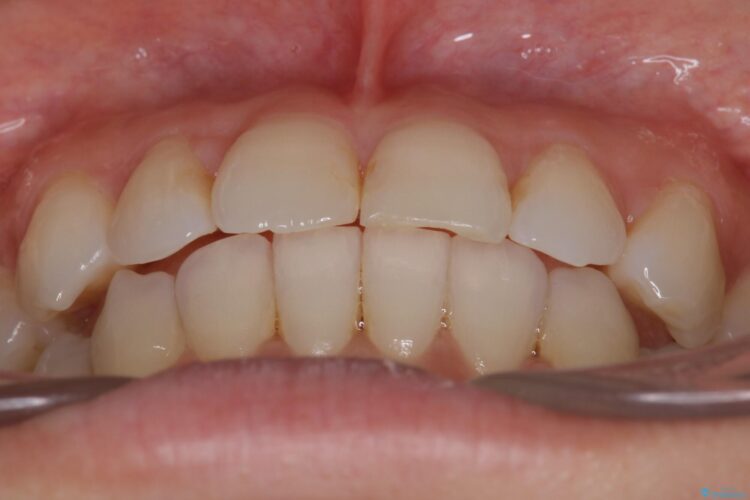 八重歯と前歯のガタガタをインビザラインで 治療後画像