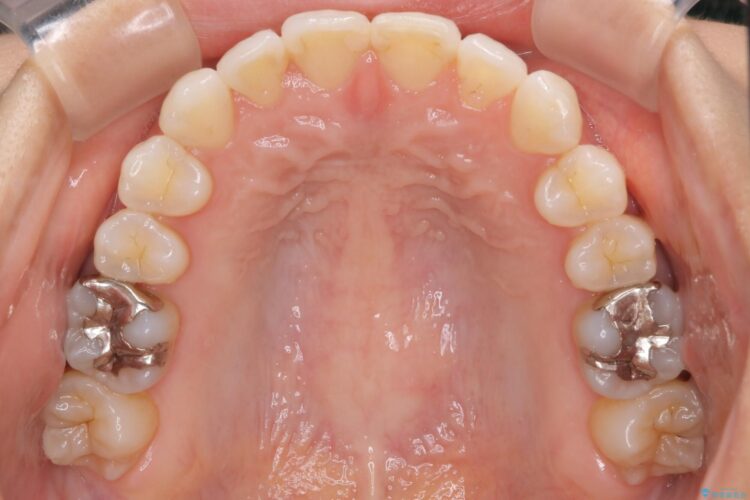 八重歯と前歯のガタガタをインビザラインで 治療後画像