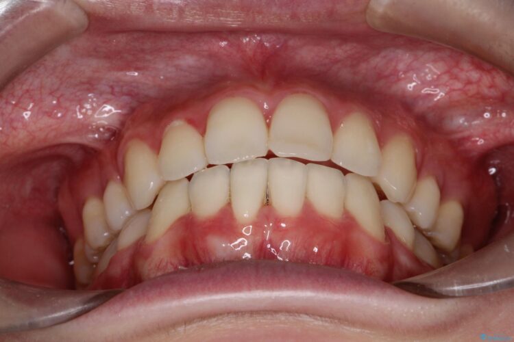 口元が出てるの気になる　ハーフリンガルによる抜歯矯正での横顔改善 治療後画像