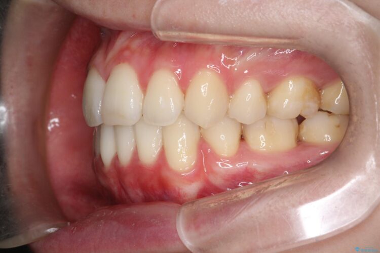 口元が出てるの気になる　ハーフリンガルによる抜歯矯正での横顔改善 治療後画像