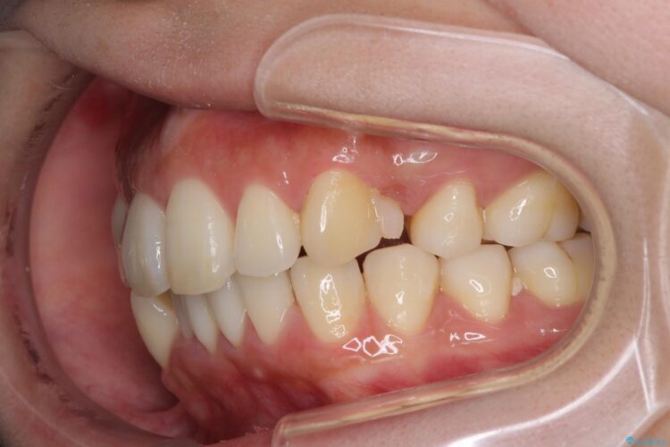 裏側装置で出っ歯の矯正治療 治療途中画像