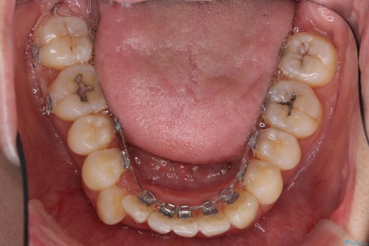 裏側装置で出っ歯の矯正治療 治療途中画像