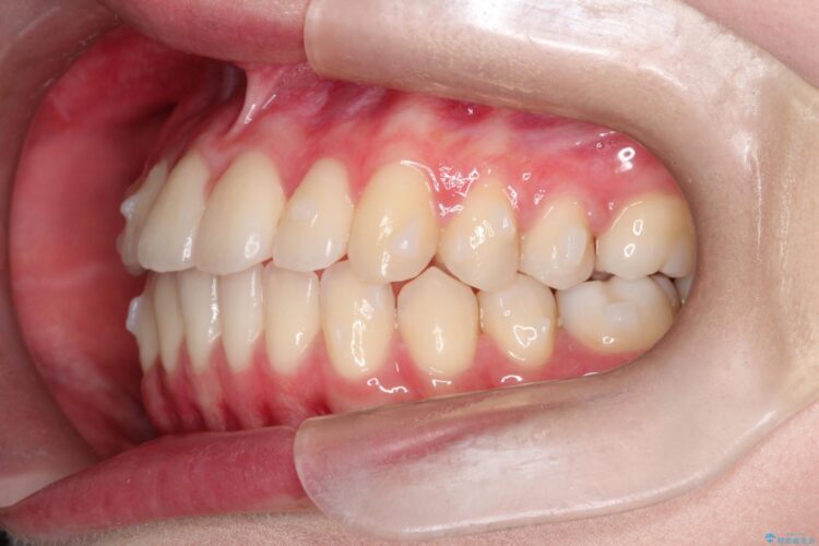 インビザラインによる非抜歯矯正　ガタガタな歯並びを整った歯並びへ 治療途中画像