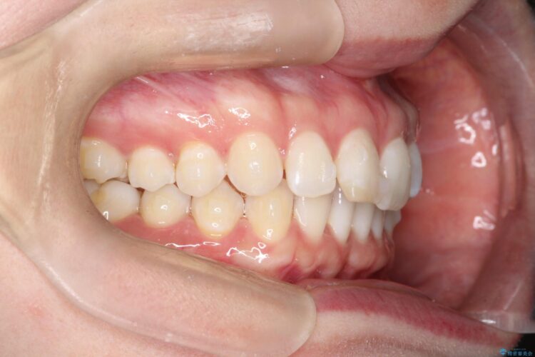 すきっ歯をインビザラインで目立たたずストレスなく矯正 治療途中画像