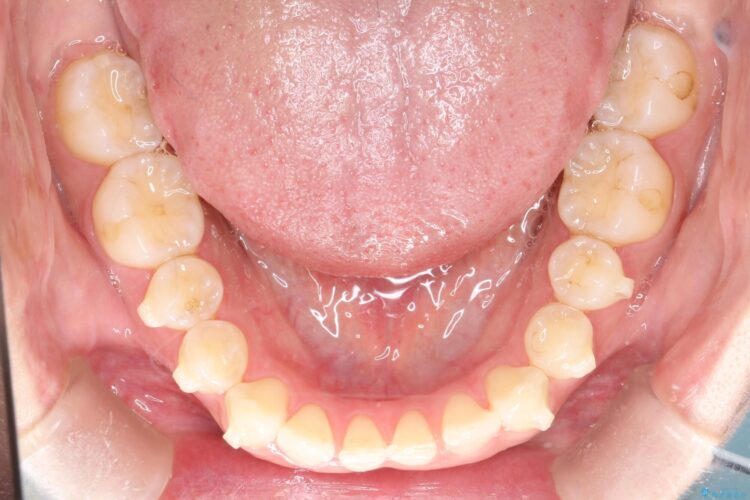 すきっ歯をインビザラインで目立たたずストレスなく矯正 治療途中画像