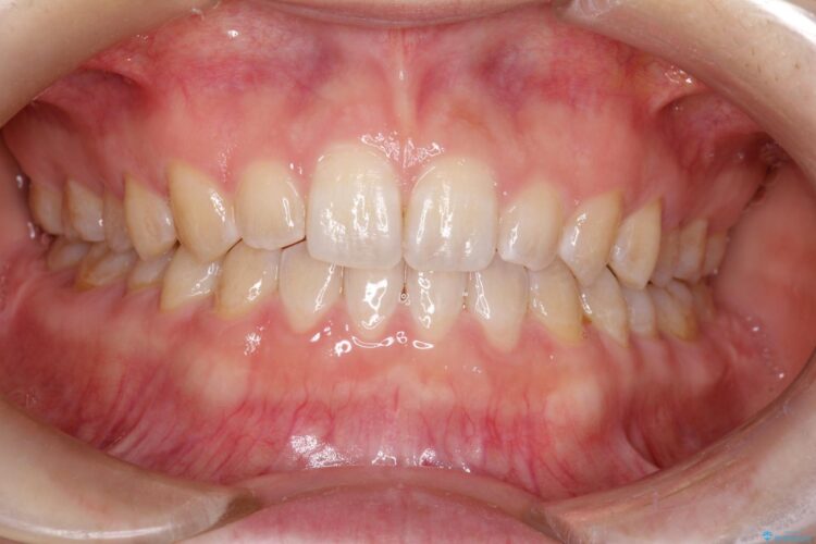 前歯の隙間を閉じたい　インビザラインによる矯正 アフター