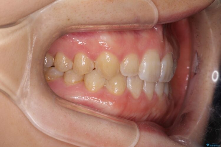 前歯の隙間を閉じたい　インビザラインによる矯正 治療後画像