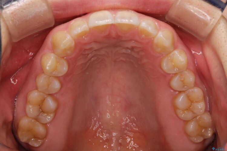 前歯の隙間を閉じたい　インビザラインによる矯正 治療後画像