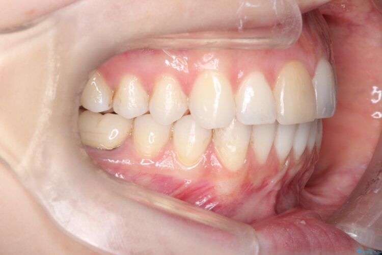 インビザラインによる非抜歯での八重歯の矯正 治療後画像