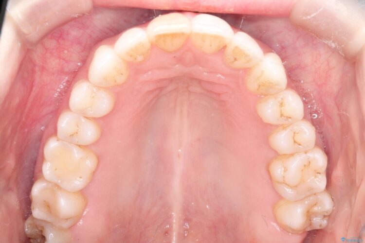 インビザラインによる非抜歯での八重歯の矯正 治療後画像