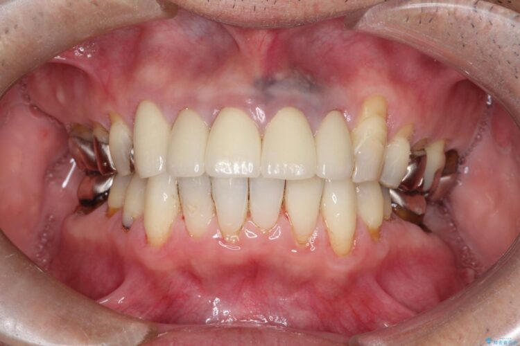 上の前歯の根元が黒い　根の治療を含めたセラミック再治療 アフター